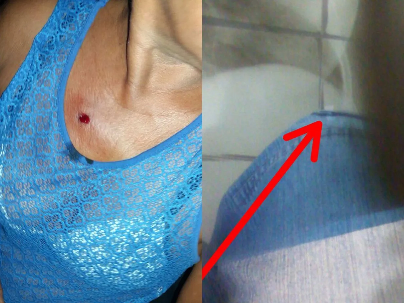A Bala de chumbinho ficou alojada