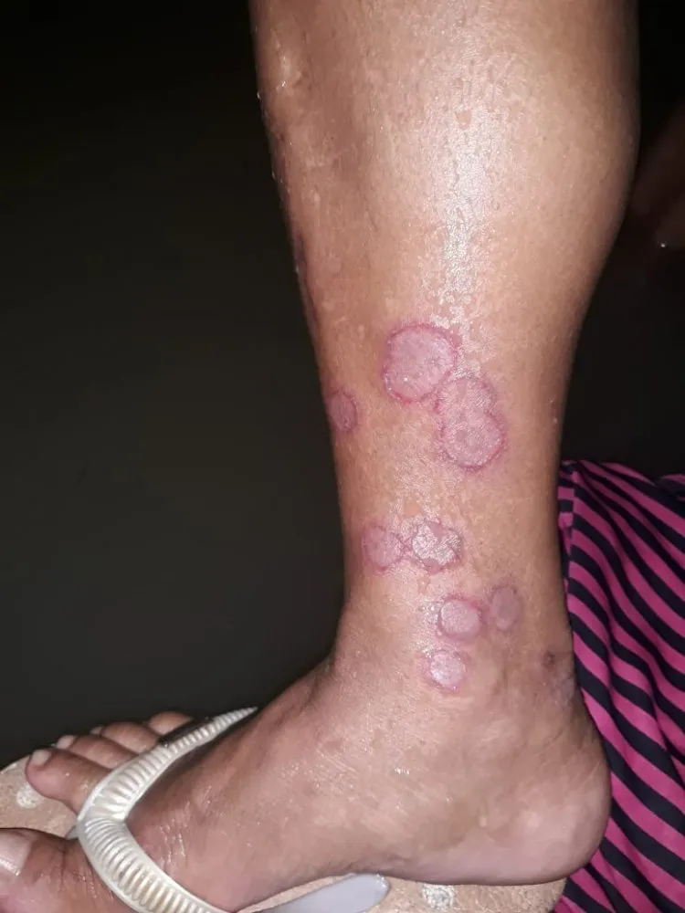 Perna da idosa com feridas causadas pelo contato diário com a água contaminada